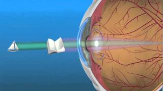 Multifocal Lens IOL [upl. by Eelrefinnej250]