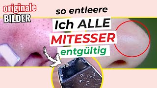 🚫👃 Mit dieser Methode Mitesser KOMPLETT entfernen  Einfacher gehts nicht  Mitesser loswerden [upl. by Rafaela]