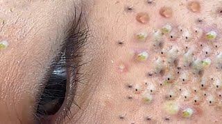 Big Cystic Acne Blackheads Extraction Blackheads amp Milia Whiteheads Removal Pimple Popping  5535 [upl. by Fasto]