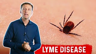 7 Weird Lyme Disease Symptoms that You Need to Know – DrBerg [upl. by Adroj385]