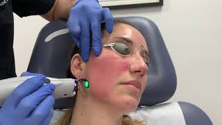 Treating Rosacea my IPL experience [upl. by Prochoras]