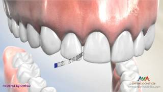 Interproximal Reduction or IPR  Polishing Strip [upl. by Olram]