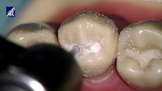 Class I Cavity Preparation Tooth 44 [upl. by Zilevi]