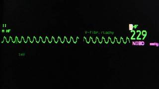 Ventricular tachycardia on an ECG monitor [upl. by Madi]