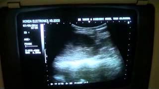 PYELONEPHRITIS vs INTERSTITIAL NEPHRITIS vs NEPHROTIC SYNDROME [upl. by Leihcey688]