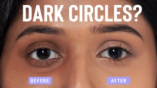 Home remedies to remove dark circles QUICKLY and NATURALLY [upl. by Goines]