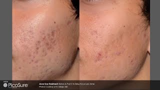 Laser Acne Scar Removal  Pulse light Clinic London [upl. by Takakura]