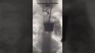 A tracheoesophageal fistula TEF radiology paediatric clinical neetpg [upl. by Ylecic]