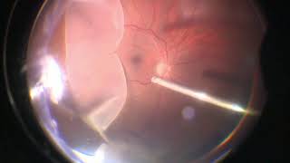 Vitrectomy for Giant Retinal Tear  Retinal Detachment  GRT  Dr Manish Nagpal [upl. by Nimar]