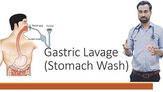 GASTRIC LAVAGE STOMACH WASH STOMACH IRRIGATION ICU PROCEDURE DR SALMAN NASIR [upl. by Kara]