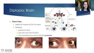 Lecture Prescribing Prism for Diplopia in NeuroOphthalmic Disorders Part II [upl. by Lisan]