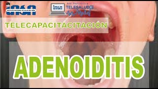 Adenoiditis  Telecapacitación INSN [upl. by Klemens]