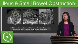 Bowel Obstruction and Ileus Ileus amp Small Bowel Obstruction – Radiology  Lecturio [upl. by Aicxela]