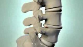 Herniated Disc  DePuy Videos [upl. by Ydnis]