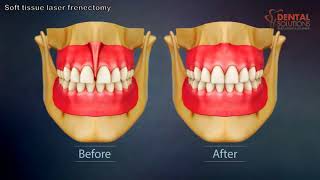 Soft tissue laser frenectomy for reducing gap between teeth [upl. by Tommy]