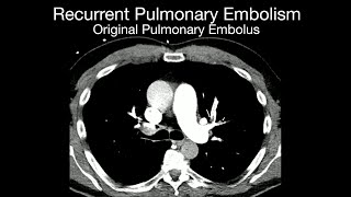 Recurrent Pulmonary Embolism [upl. by Loralee]