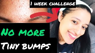 How to remove Tiny Bumps Naturally in 7 days  Home Remedy for Tiny Bumps  Self Care Secrets [upl. by Aniteb]