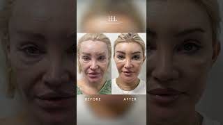 Revision Facial Surgery revisionplasticsurgery drharrisonlee [upl. by Daryn]