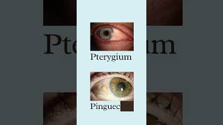 Pinguecula vs pterygiumpinguecula pterygium eyedisease eyeinfection [upl. by Noemad978]