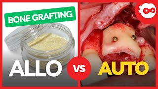 Allo vs Autograft for Dental Implants [upl. by Charteris]