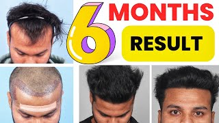 Best Hair Transplant Result Without Shedding Phase  Why Crown Hair Transplants Are Not Successful [upl. by Yroggerg]