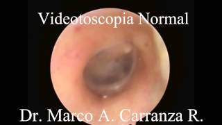 Video Otoscopia Normal [upl. by Doownel59]