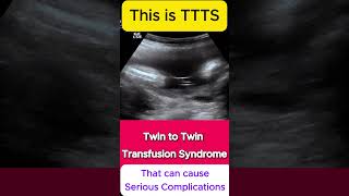 TTTS  Twin to Twin Transfusion Syndrome Ultrasound  Monochorionic TWINS [upl. by Haldas]