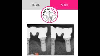 How to treat periodontitis amp periimplantitis nonsurgically with CLEANampSEAL [upl. by Orbadiah]