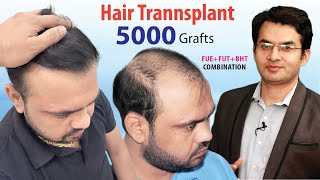 5000 Grafts Hair Transplant Results in Grade 6 by Dr Suneet Soni at Medispa Hair Transplant [upl. by Bone]