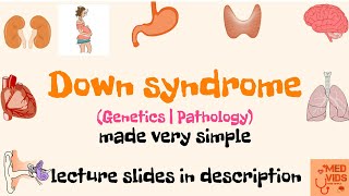 Down syndrome  Genetics  Pathology  Med Vids made simple [upl. by Snowber]