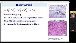 Discovering Genetic Causes of Biliary Atresia  A Heterotaxic Condition  Saul J Karpen MD PhD [upl. by Nnaarual]