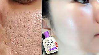 How to use Lacto Calamine Lotion  Lacto Calamine Lotion For Clear Spotless Brighten Skin [upl. by Ime]