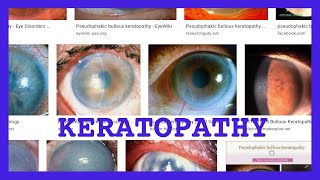 keratopathy [upl. by Hgeilyak135]