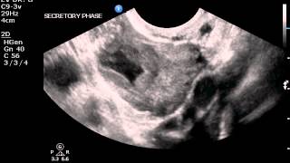 Transvaginal ultrasound of corpus luteum cyst no color [upl. by Ocirema]