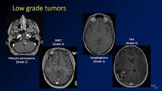 Imaging brain tumors  4  Other low grade gliomas [upl. by Roydd]