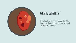 Cellulitis Causes Symptoms Diagnosis and Treatment  Merck Manual Consumer Version Quick Facts [upl. by Nanci509]