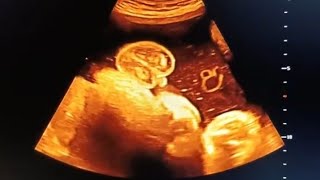 Boy or girl baby ultrasound subscribe babyboy babyb [upl. by Jesher]