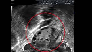 Antral Follicle Counts in Real Time [upl. by Ursal]