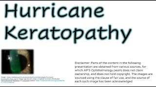 Hurricane Keratopathy [upl. by Anwahsak]