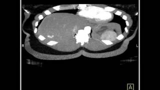 Abdomen Liver Hemangioma of the Liver4 of 8 [upl. by Aniretake]