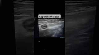 Échographie pelvienne Appendicite aigue non compliqué flowers docteur échographie medical [upl. by Eade]