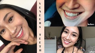 My Glamsmile Veneers Experience [upl. by Smaoht]