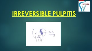 IRREVERSIBLE PULPITIS IRREVERSIBLE PULPITIS  HINDI [upl. by Eniaj537]