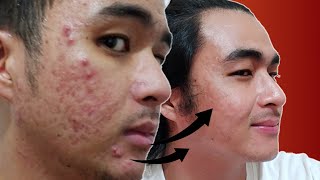 BEST ISOTRETINOIN TIMELAPSE ON YOUTUBE  Acnetrex Journey for 8 Months in 2 Minutes  KevInSeries [upl. by Ndnarb]