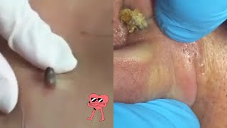 Ultimate Pimple Popping Extravaganza 2024 💥👀 [upl. by Brew]