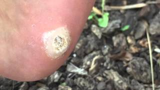 Massive Plantar Wart At home removal attempt [upl. by Ayek]