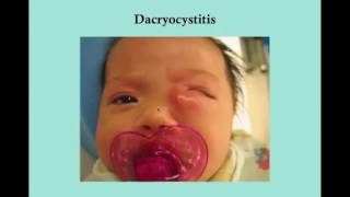 Dacryocystitis CRASH USMLE Step 2 and 3 [upl. by Myk]