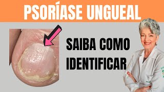 Como Identificar a Psoríase Ungueal Corretamente [upl. by Anya612]