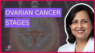 The 4 Stages of Ovarian Cancer by Dr Ruchi Garg [upl. by Agueda108]