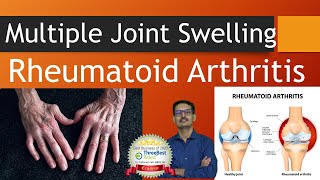 Pain and Swelling in Multiple Joints Rheumatoid Arthritis English [upl. by Townie909]